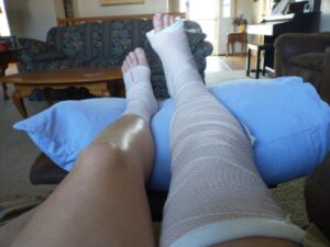 A broken leg story — Michelle Kaderly Welsh